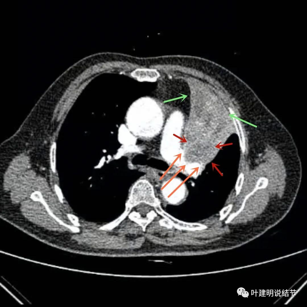 高龄肺癌靶向治疗效果,高龄老人肺癌早期适合放疗吗