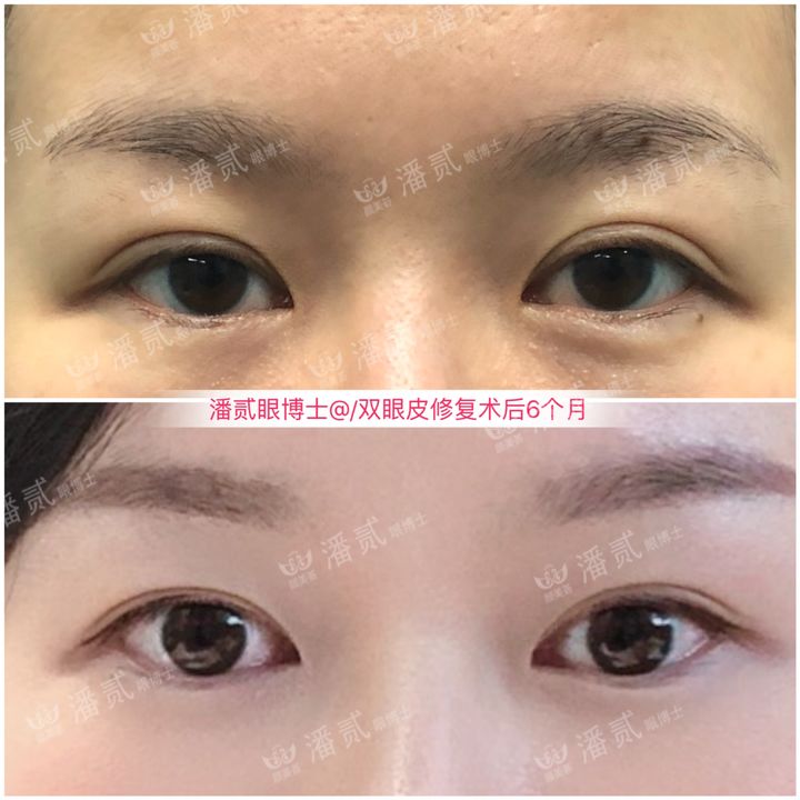 韩式三点式双眼皮手术很疼吗,韩式三点双眼皮做的不好看