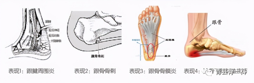 脚膝盖侧面的筋疼痛是什么原因,脚后大筋和脚侧面痛怎么回事
