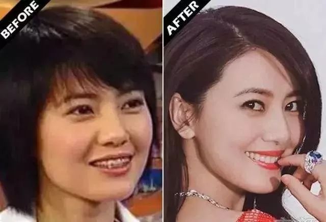 刘涛是全口瓷牙,演员刘涛的一口烤瓷牙多少钱