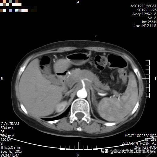 河南省肿瘤医院射波刀治疗胰腺癌,郑大第一附属医院治疗胰腺癌