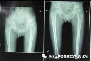 蜡泪样骨病能治愈吗,蜡泪样骨病什么意思