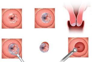 感染了hpv就一定会得宫颈癌吗,感染hpv才会得宫颈癌吗