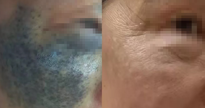 脸上长了一块灰褐色的斑,脸上有大块灰斑怎么办