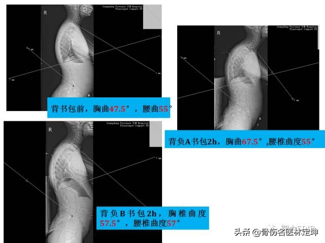 对孩子脊柱好的书包,书包对脊柱侧弯的影响