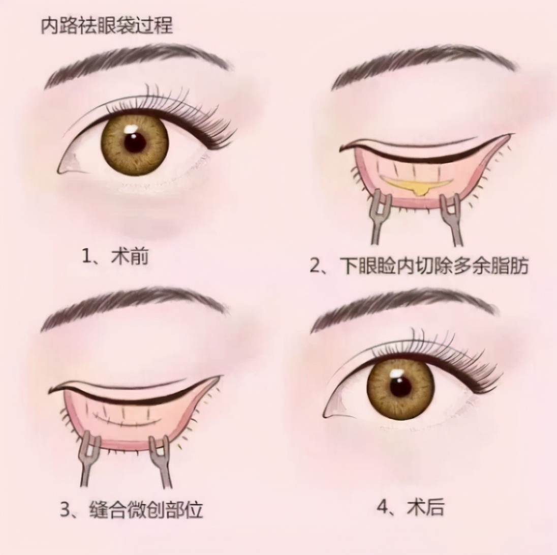 眼袋黑眼圈最好的解决方法,眼袋加黑眼圈最好的解决办法