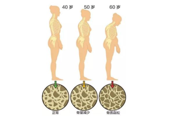 老年人髋部骨折打钢板,老年人髋部骨折症状