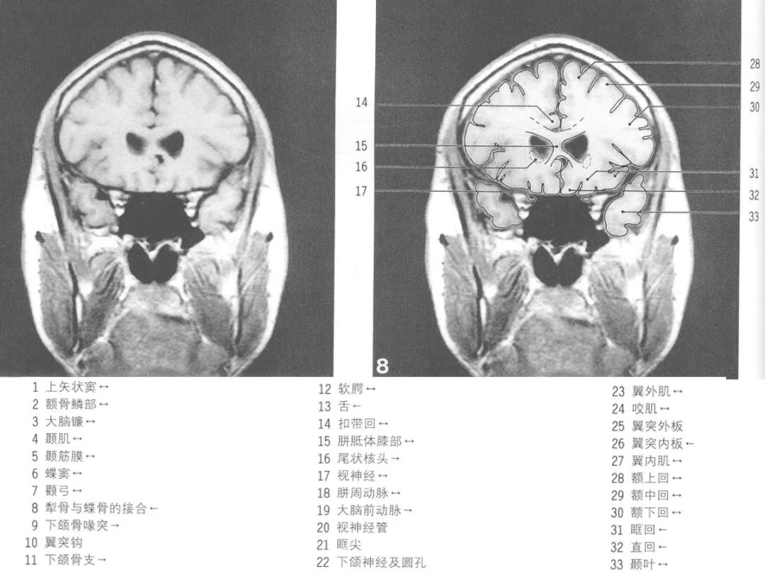 颅脑冠状状切面解剖图,颅脑mr解剖结构图