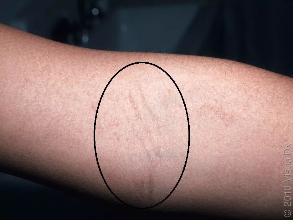 发热出红疹子可以吃过敏药吗,发热皮疹会反复么