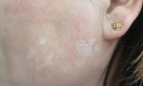 白斑和白癜风的鉴别方法,白癜风和日光性白斑鉴别诊断