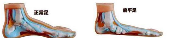 家长如何帮助矫正扁平足,孩子扁平足用不用治