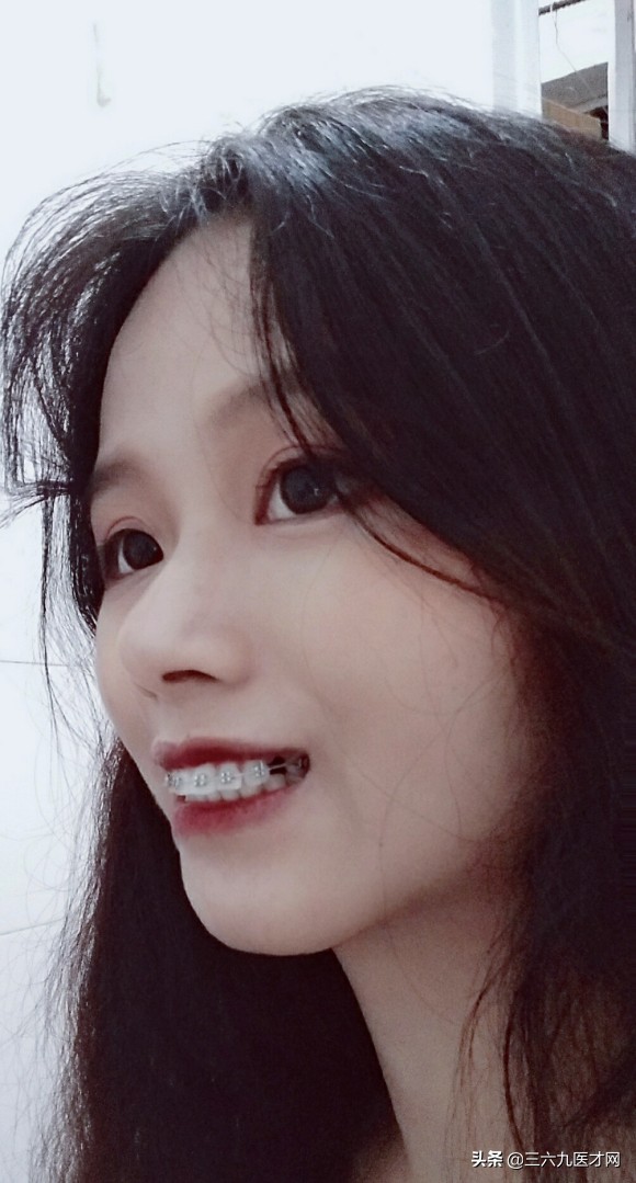 龅牙矫正成功的图片对比,2周岁龅牙可以矫正吗