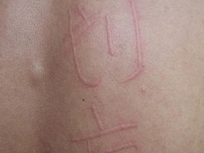 人工性荨麻疹是怎么引起的,人工性荨麻疹都有什么症状