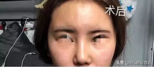 诺德整形医院失败案例,诺德整形鼻子