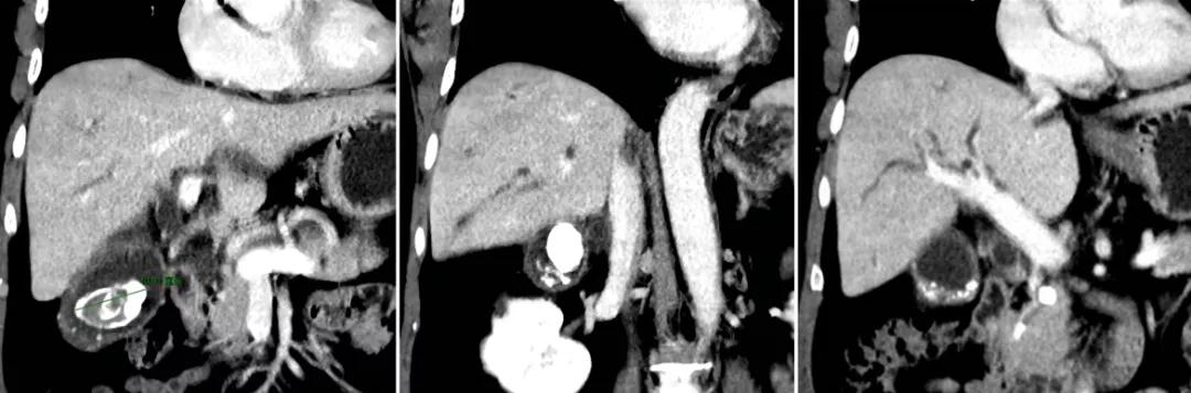 到底是保胆好还是切除好,怎么手术保胆