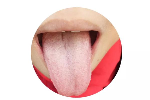 舌苔脉象与病症的关系的对应表,舌苔和病情