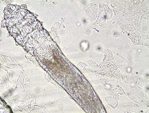 鼻子挤出白粒是螨虫吗,鼻子毛孔里挤出白色膏状物怎么办