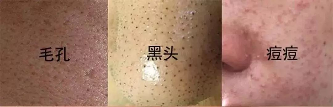 脸油痘痘多黑头用什么简单洗干净,清理黑头痘痘的最简单方法