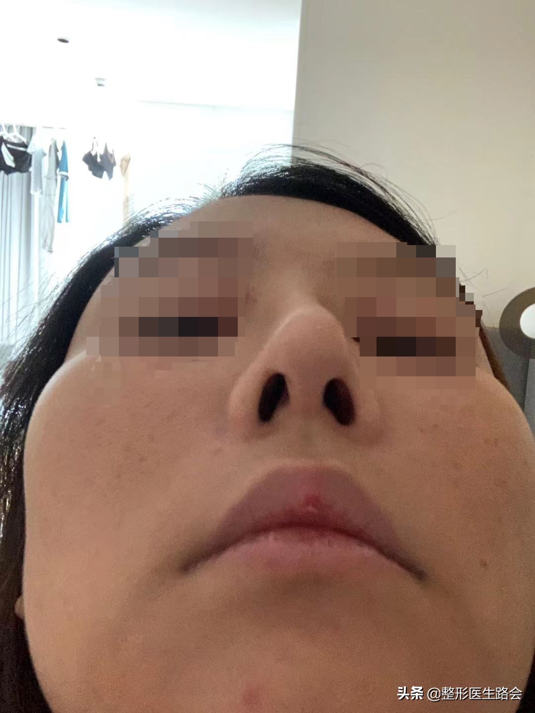 一定得惊艳才好看吗,膨体鼻整形全过程