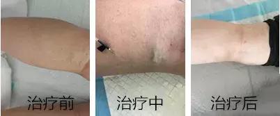 蚯蚓腿新式微创治疗,蚯蚓腿微创手术