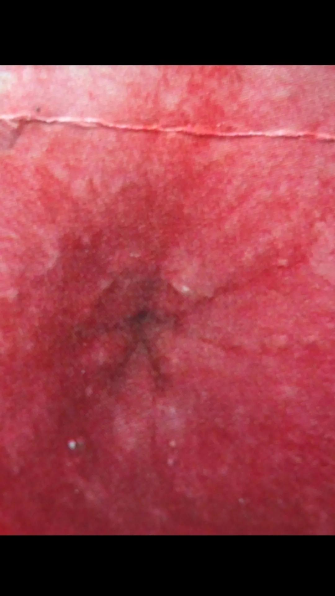 急性胃炎的症状及治疗方法,急性胃炎分类