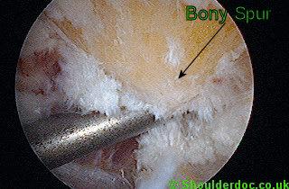 左侧肩膀疼痛预示十种病,哪些病可引起肩膀痛后背痛颈椎痛