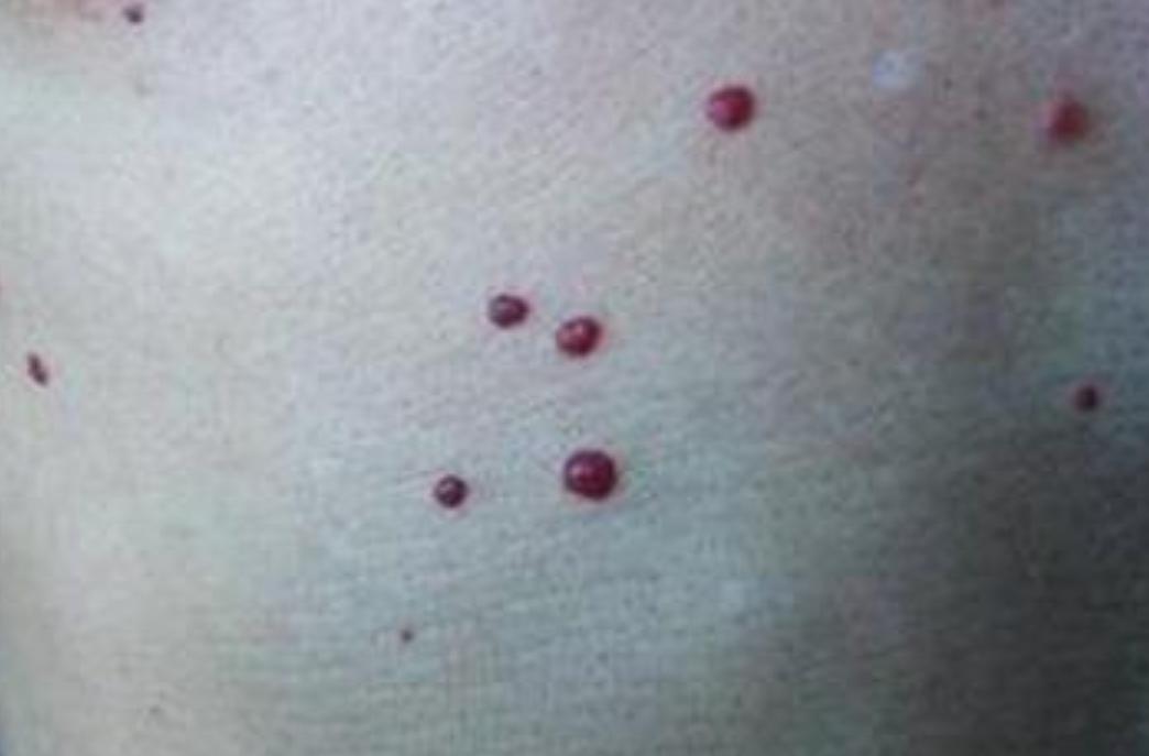 身上的痣自己会消除吗,身上的痣能随便去掉会死吗