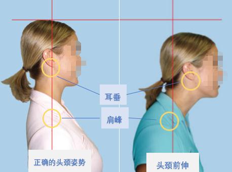 颈椎生理曲度变直严重吗要治疗吗,颈椎胸椎生理曲度变直症状