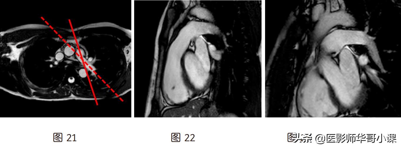 心脏mr增强扫描讲解,磁共振心脏扫描标准切面