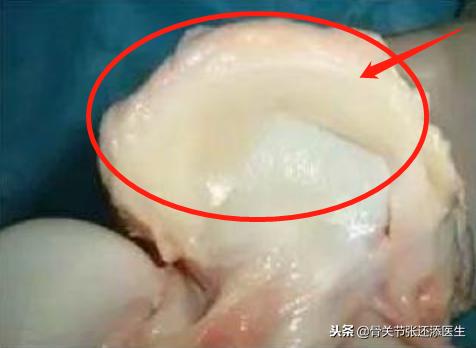 韦德的半月板撕裂到什么程度,韦德半月板损伤