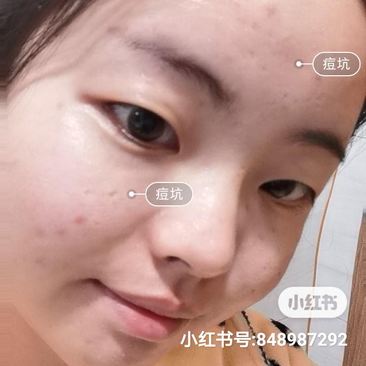 男士毛孔粗大出油痘坑痘印黑头,脸部出油有痘坑痘印毛孔粗大中医