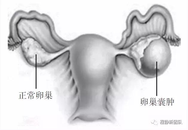 交界性浆液性卵巢囊肿可怕吗,卵巢囊肿可怕吗该如何处理