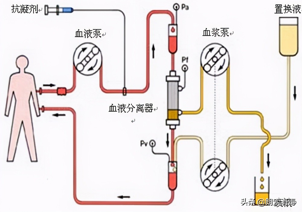 血液透析导管的护理措施,血液透析护理操作及流程ppt