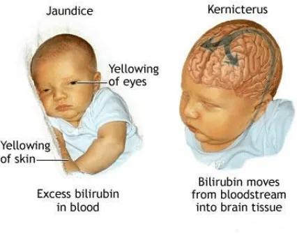 新生儿高胆红素血症是什么黄疸,新生儿高胆红素血症是病理黄疸吗
