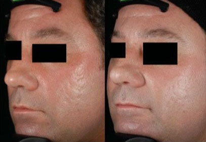 脸上痘印痘坑怎么消除最有效,痘坑怎么才能彻底解决