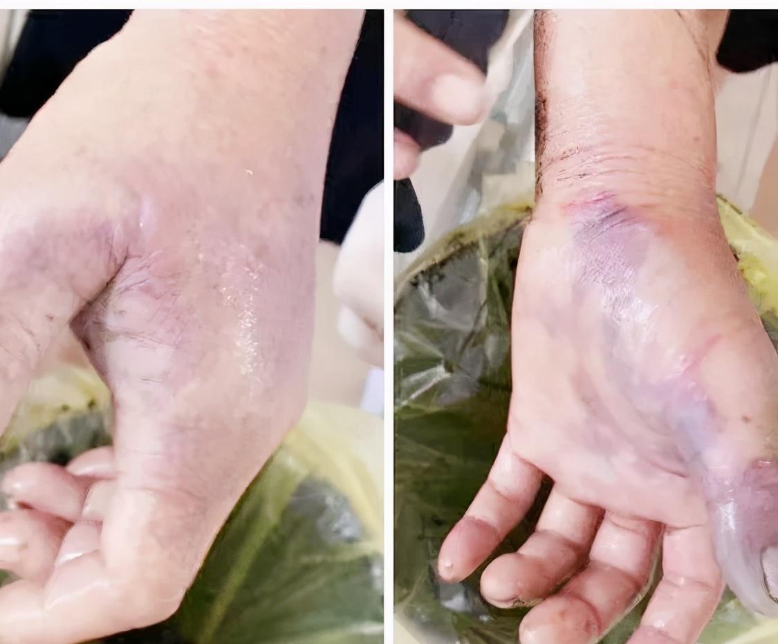 杀鱼被鱼刺刺伤手红肿,大爷杀鱼时鱼刺扎手上中毒身亡