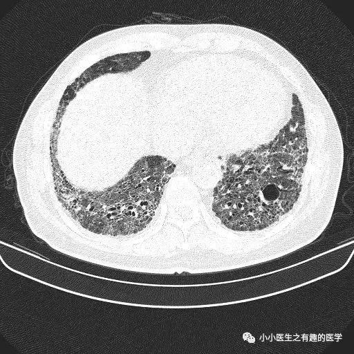 间质性肺炎CT诊断,间质性肺炎ct诊断报告