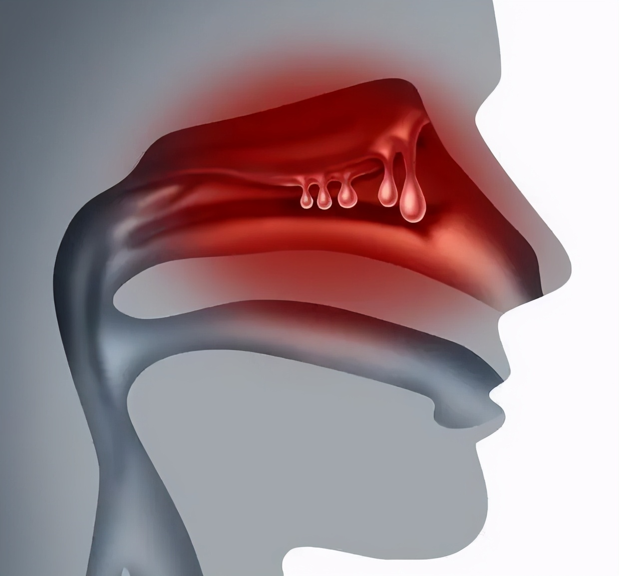 鼻炎长期鼻塞吃什么药,老鼻炎患者怎么治疗