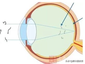 激光消融术治疗飞蚊症的亲身经历,眼睛飞蚊症怎么治疗用什么眼药水