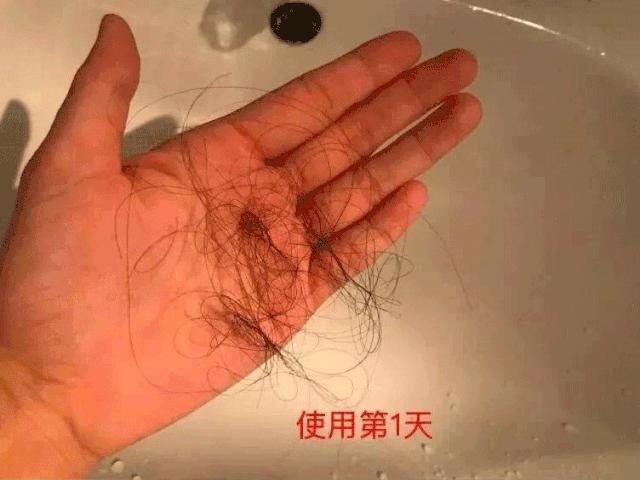 天天散着头发容易脱发吗,头发油了特别容易脱发