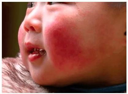 如何预防红脸蛋,怎么预防脸部红血丝