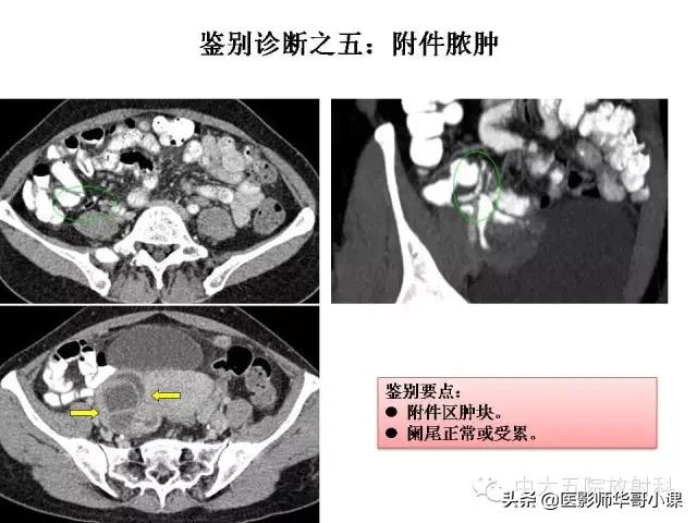 阑尾炎课件,阑尾炎的超声课件