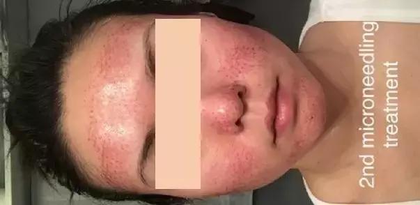 美容微针毁容视频,微针美容副作用怎么修复