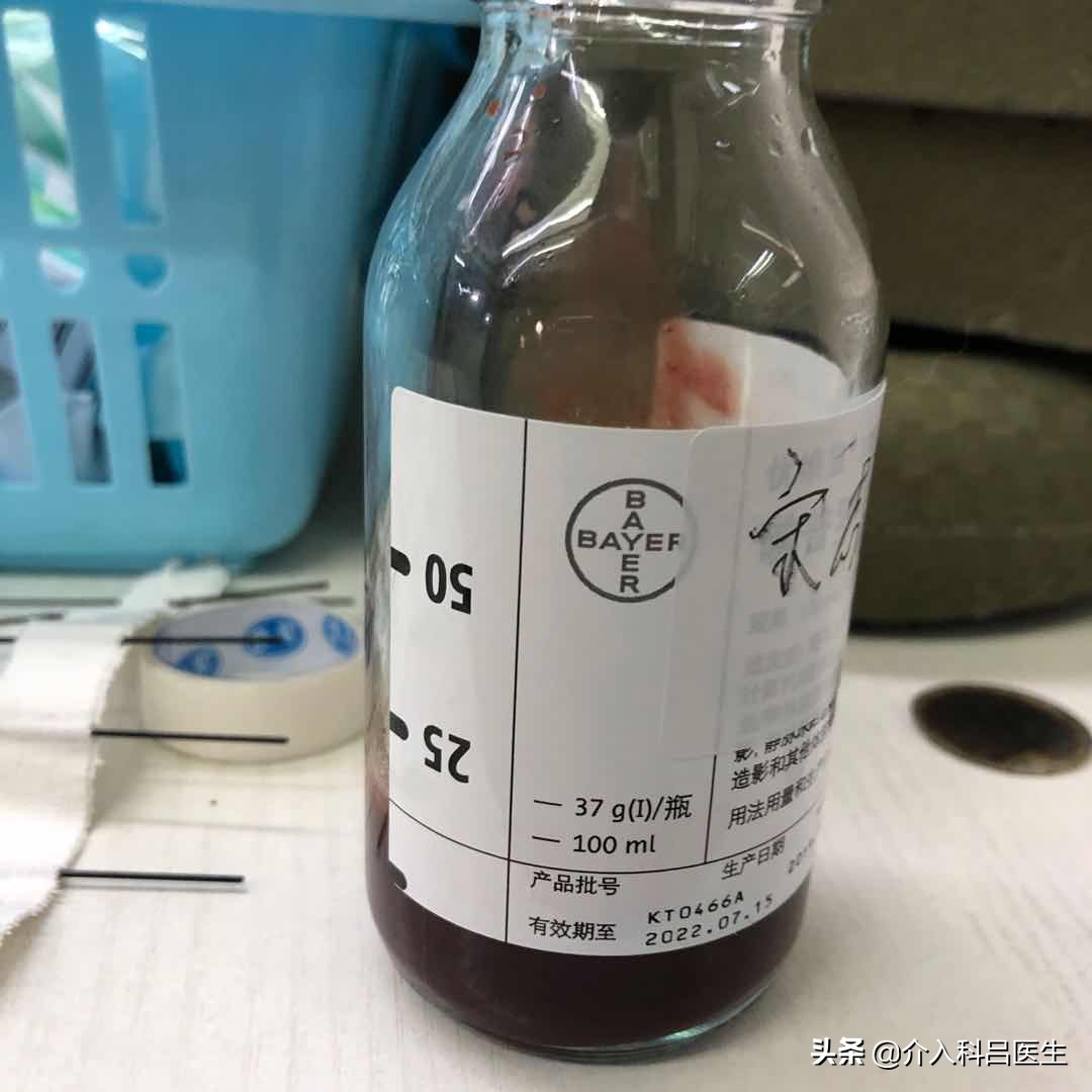 一根针治疗卵巢囊肿手术石家庄,一根针无痛消融子宫肌瘤