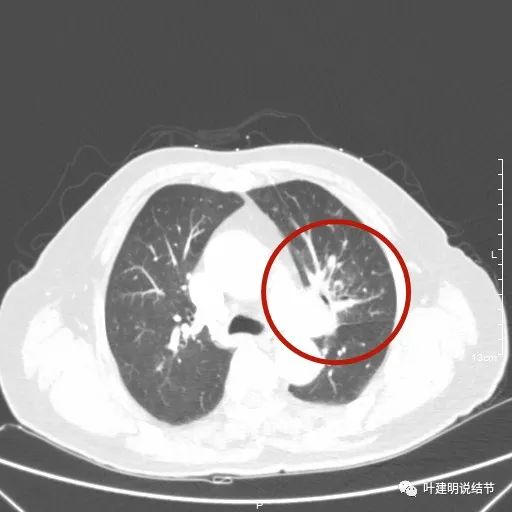 卡瑞利珠单抗治疗肺鳞癌有用吗,特瑞普利单抗对鳞癌治疗有效吗