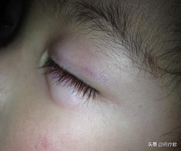 女孩把502当成眼药水滴,502胶水误当眼药水视频