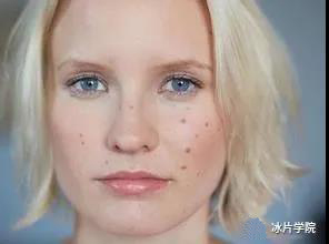 皮肤红痒长小闭口粉刺,脸上长粉刺螨虫能用硫磺软膏吗