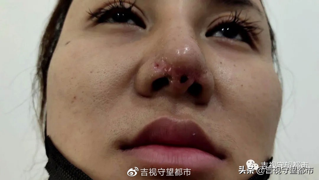 隆鼻疤痕萎缩,女子隆鼻手术后鼻子变黑