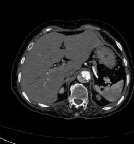 如何监测动脉夹层早期,动脉增强ct能查出主动脉夹层么