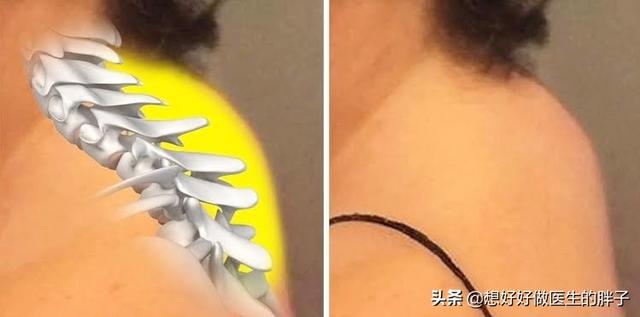 颈椎病和肥胖有关系么,脖子后面有堆肉是颈椎出问题了吗